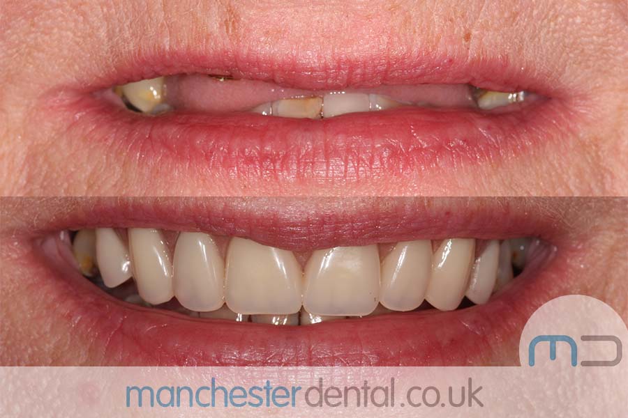 Manchester dental Dentures before and after result Manchester dental Dentures before and after result
