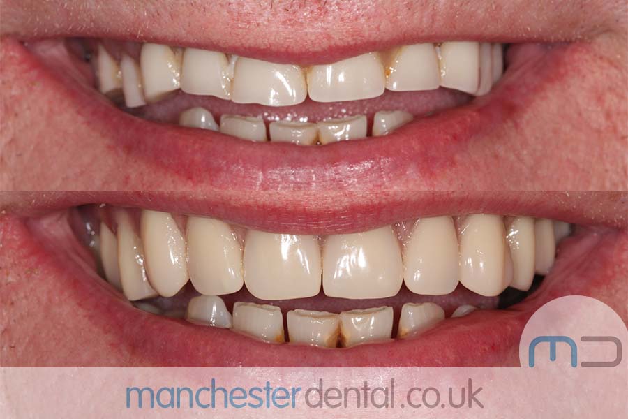 Manchester dental Dentures before and after result Manchester dental Dentures before and after result