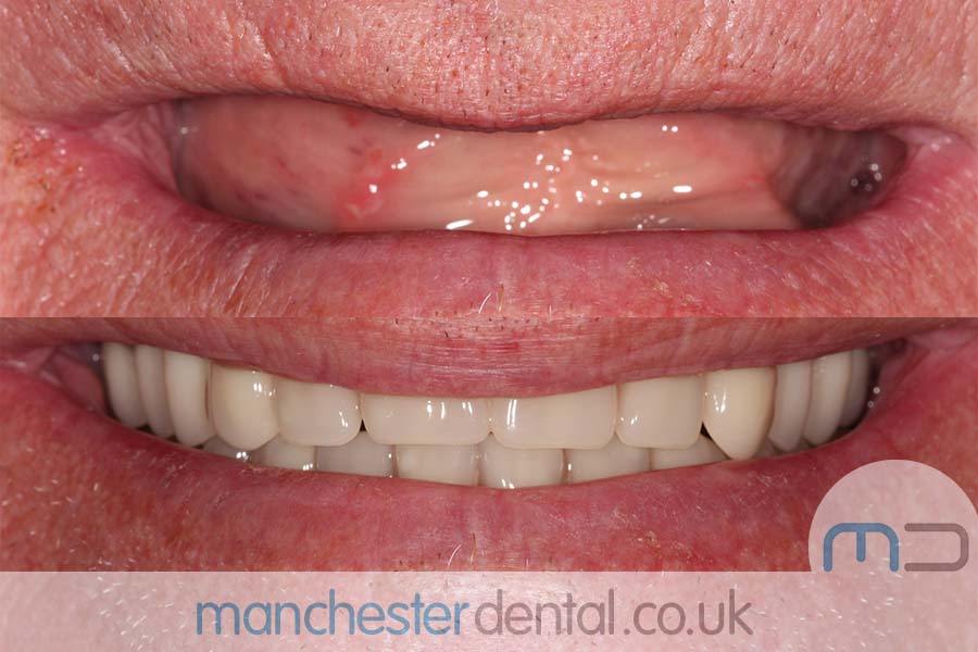 Manchester dental Dentures before and after result Manchester dental Dentures before and after result