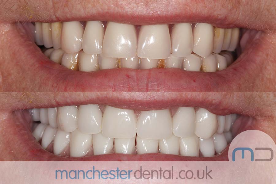 Manchester dental Dentures before and after result Manchester dental Dentures before and after result