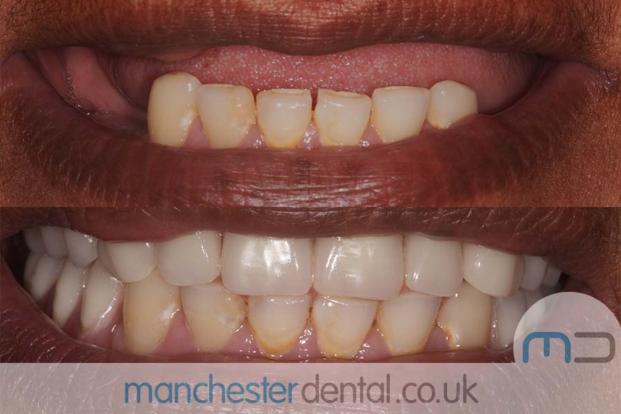 Manchester dental Dentures before and after result Manchester dental Dentures before and after result