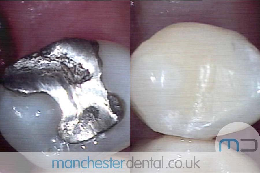 Teeth White Fillings Before and After Teeth White Fillings Before and After