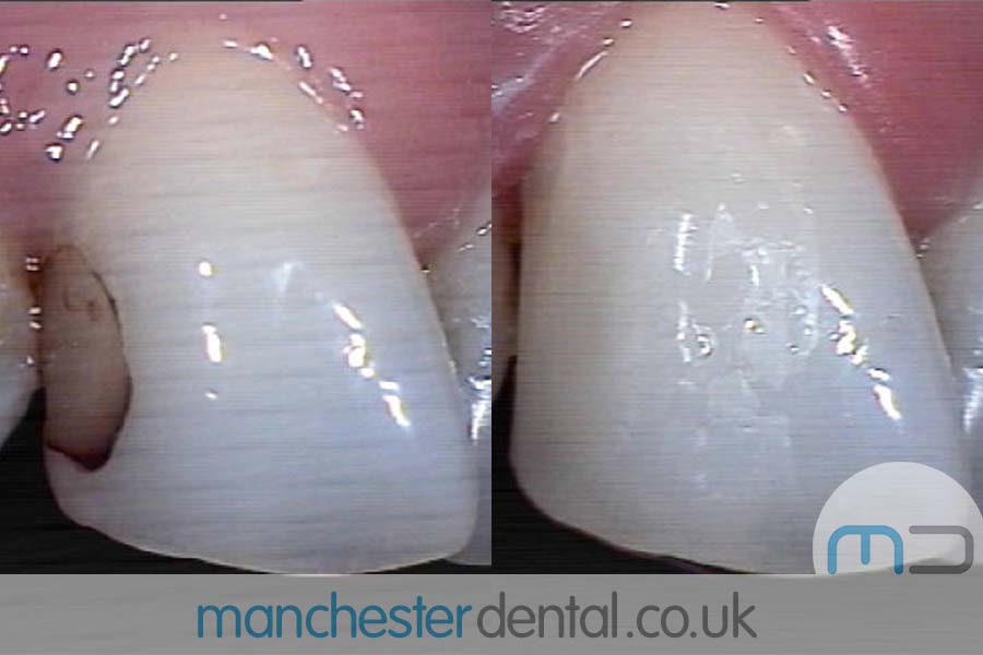 Teeth White Fillings Before and After Teeth White Fillings Before and After