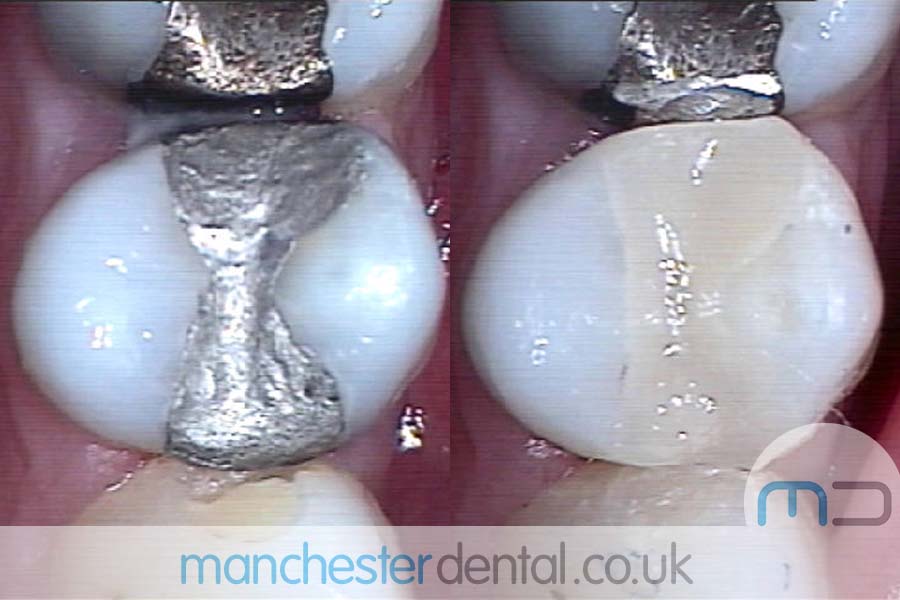 Teeth White Fillings Before and After Teeth White Fillings Before and After