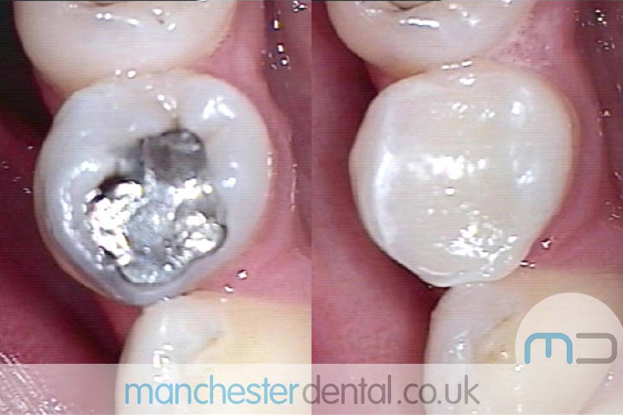 Teeth White Fillings Before and After Teeth White Fillings Before and After