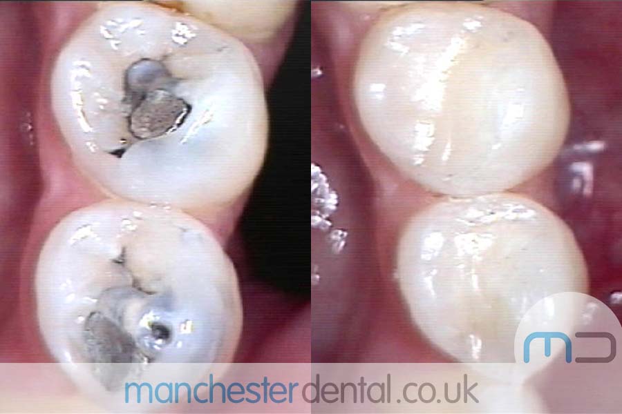 Teeth White Fillings Before and After Teeth White Fillings Before and After