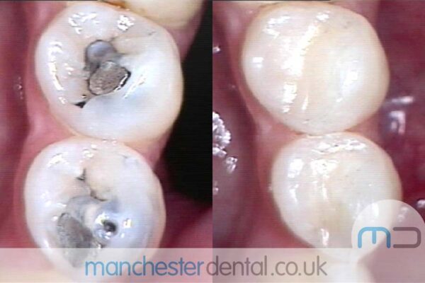 Teeth White Fillings Before and After