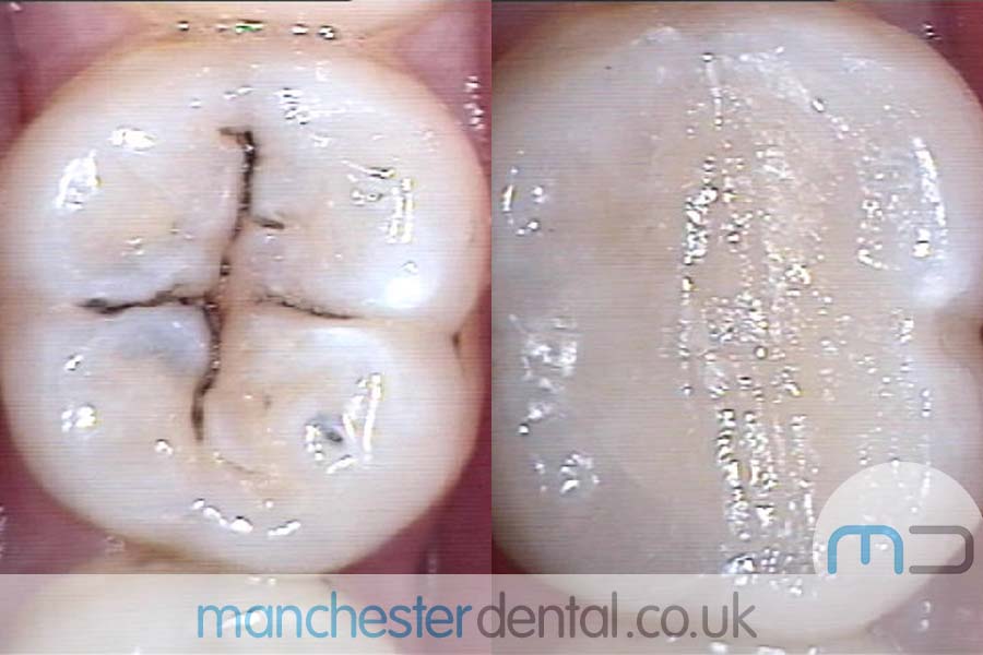 Teeth White Fillings Before and After Teeth White Fillings Before and After