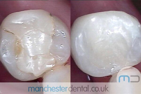 Teeth White Fillings Before and After