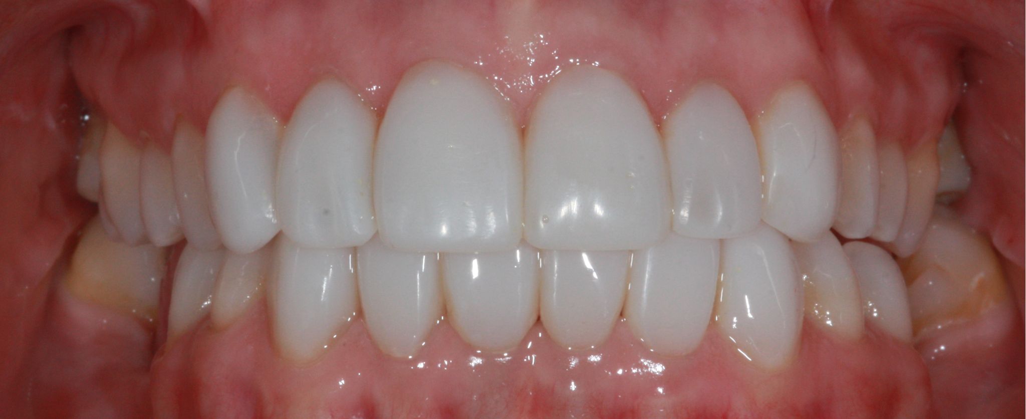 composite bonding Before and after composite bonding Before and after