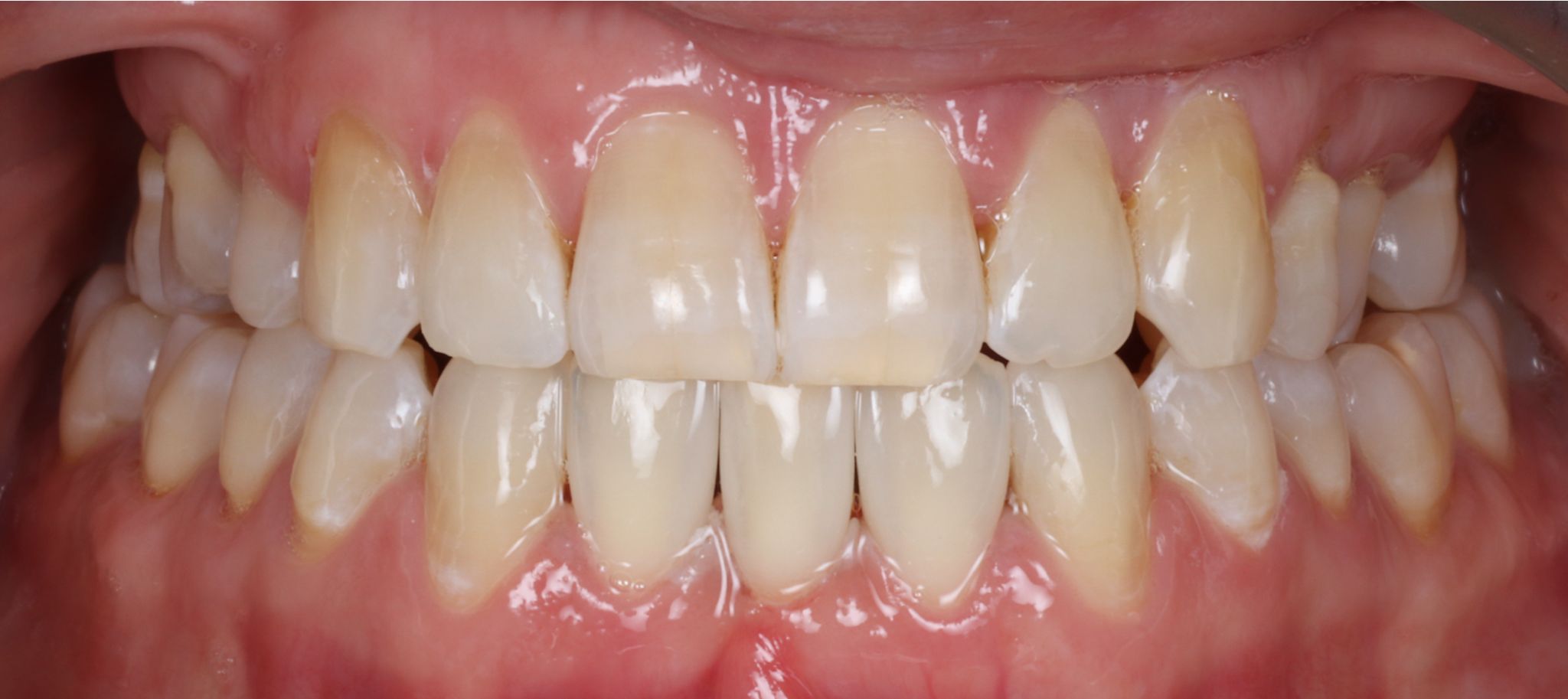 composite bonding Before and after