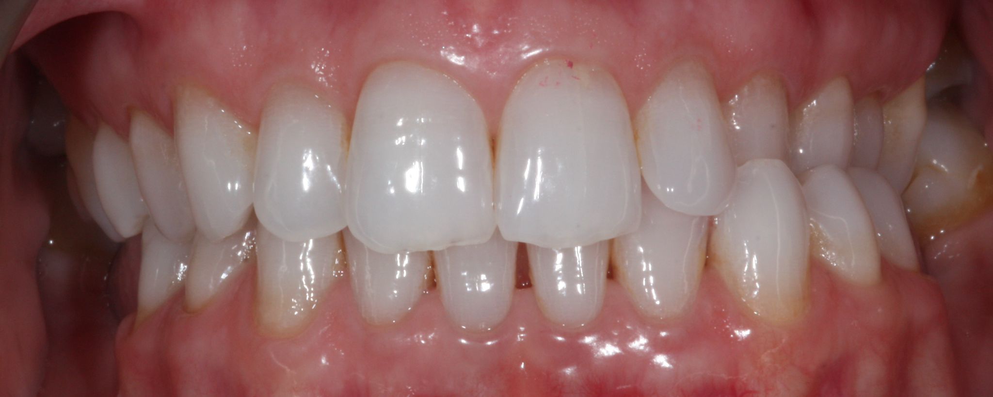 composite bonding Before and after