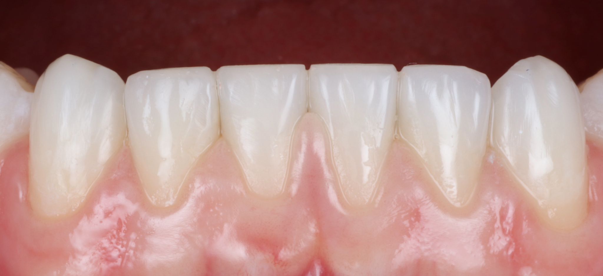 composite bonding Before and after