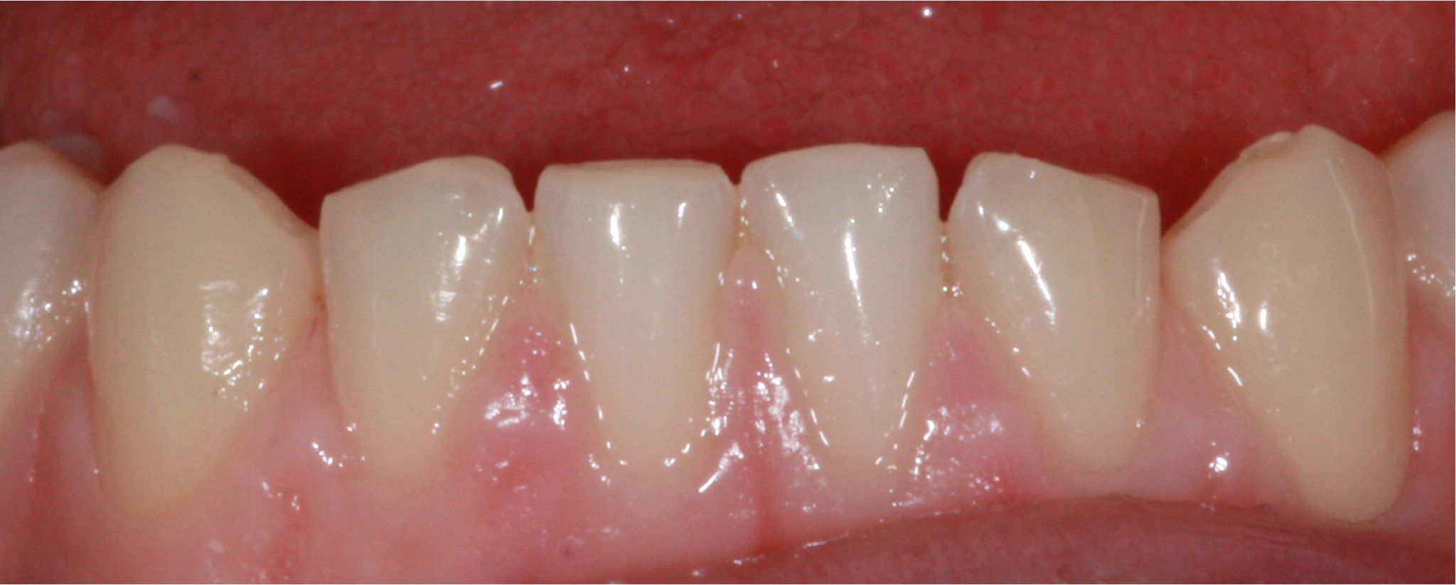 composite bonding Before and after composite bonding Before and after