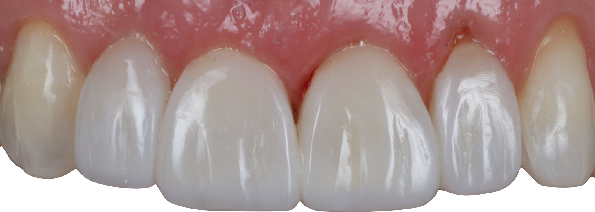 composite bonding Before and after