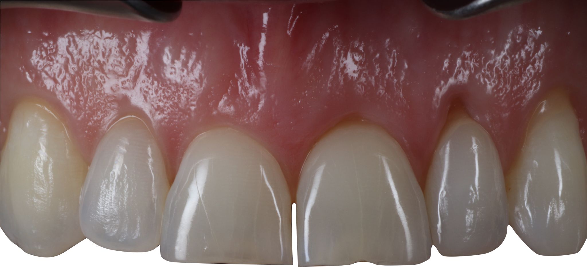 composite bonding Before and after composite bonding Before and after