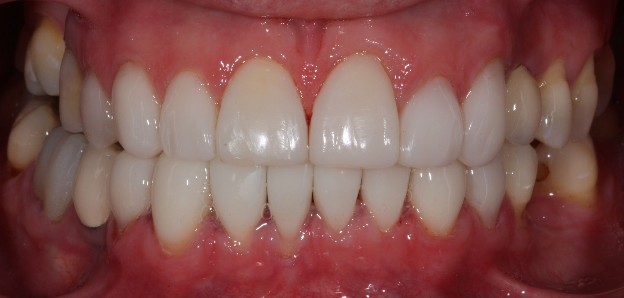 composite bonding Before and after