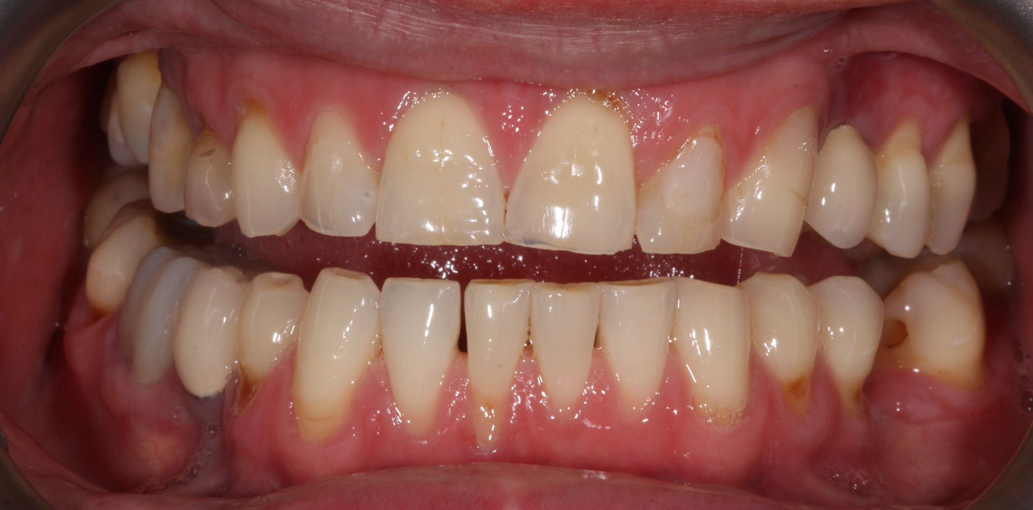 composite bonding Before and after composite bonding Before and after