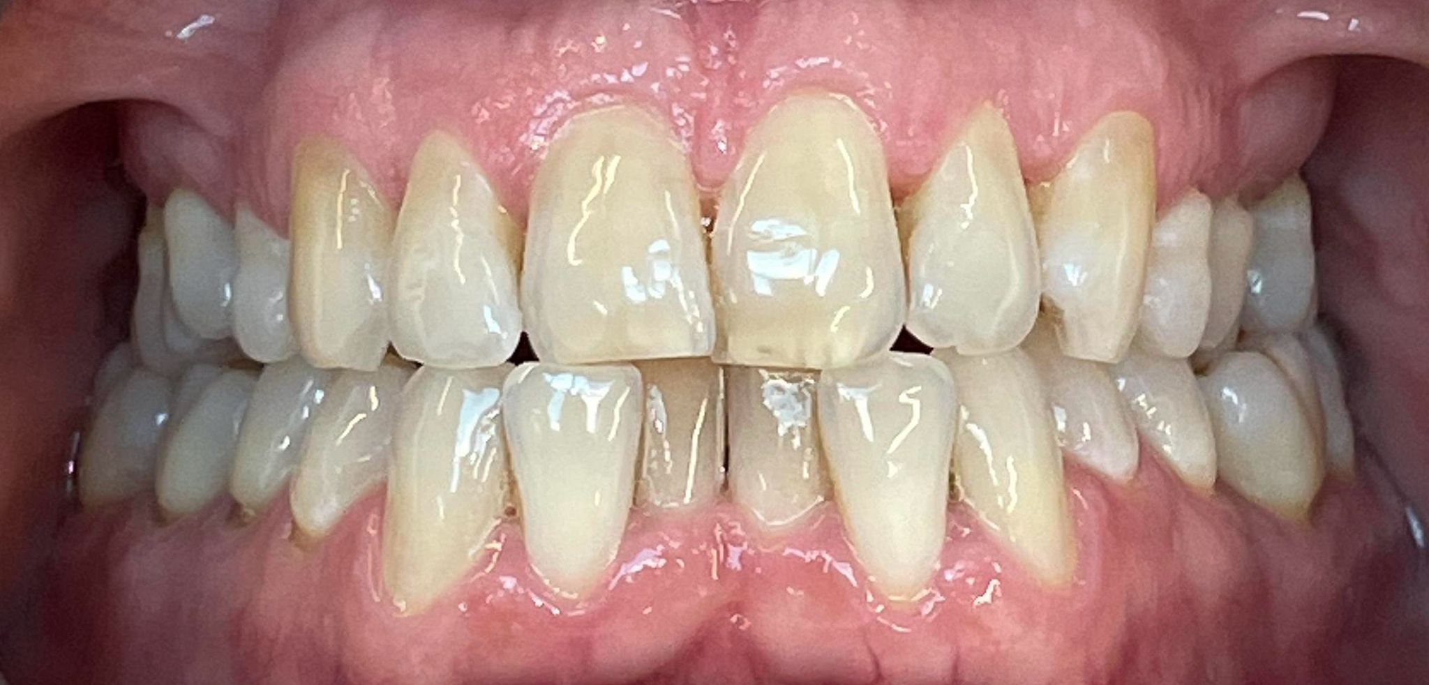 composite bonding Before and after composite bonding Before and after