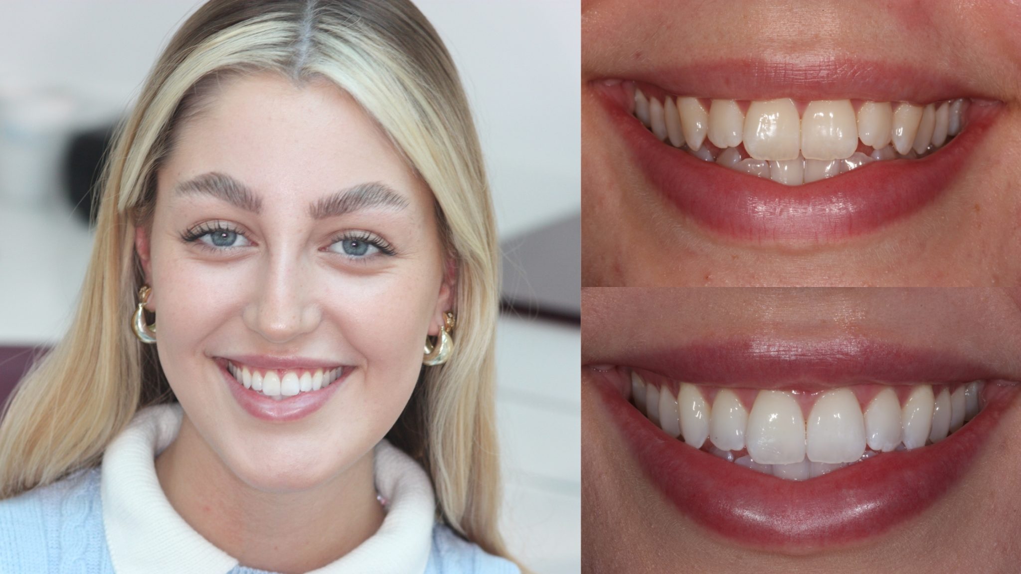 Before and after invisalign Manchester