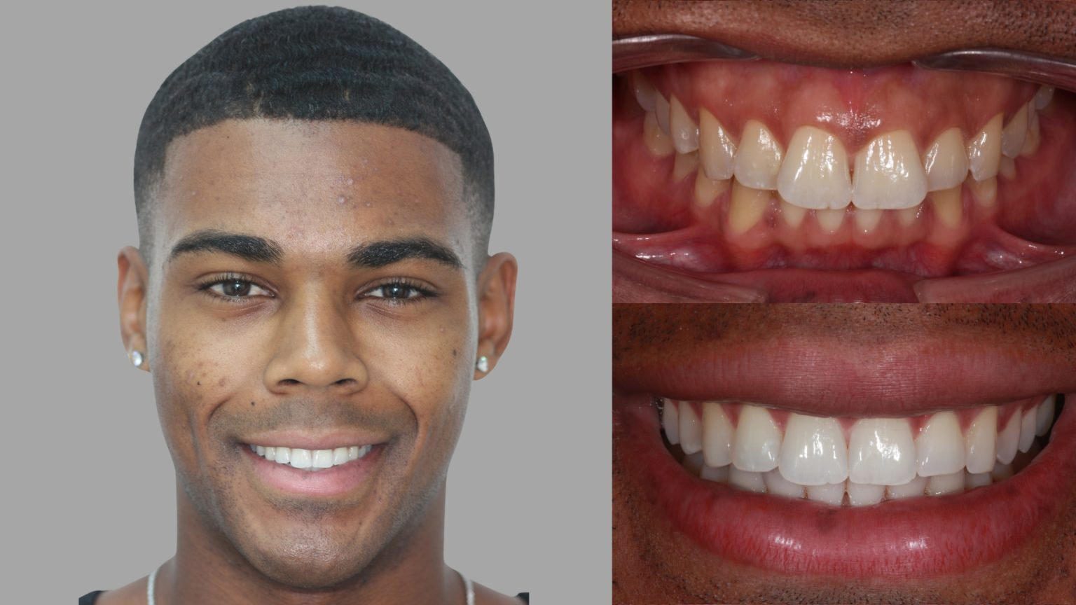 Before and after invisalign Manchester