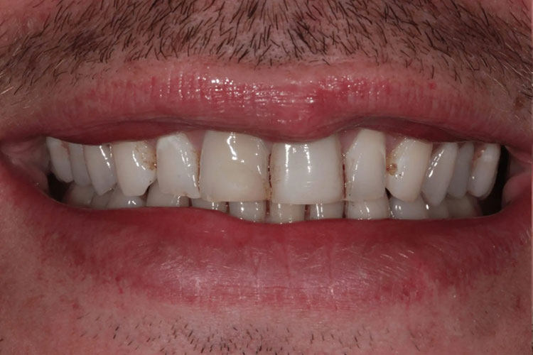 manchester dental crowns before after manchester dental crowns before after