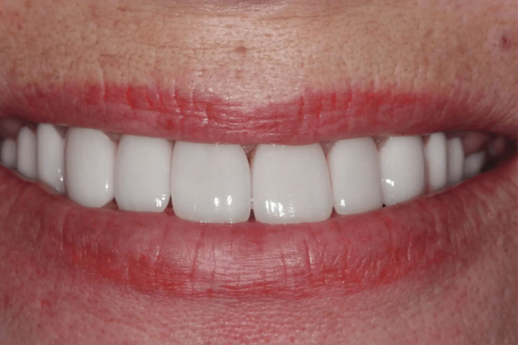 manchester dental crowns before after
