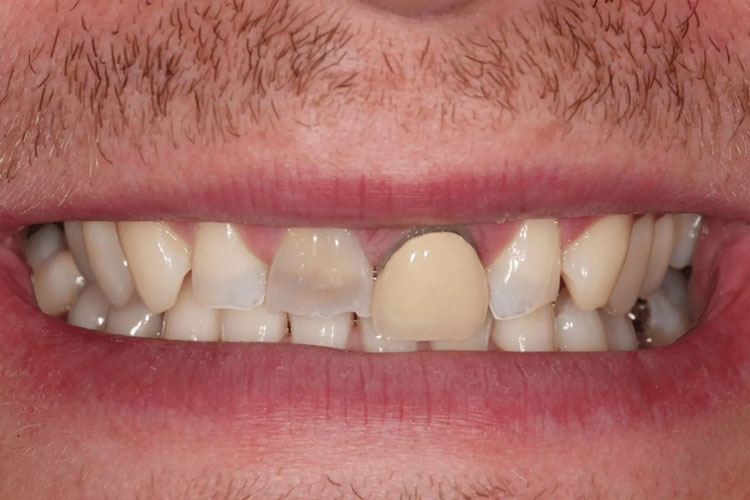 manchester dental crowns before after manchester dental crowns before after