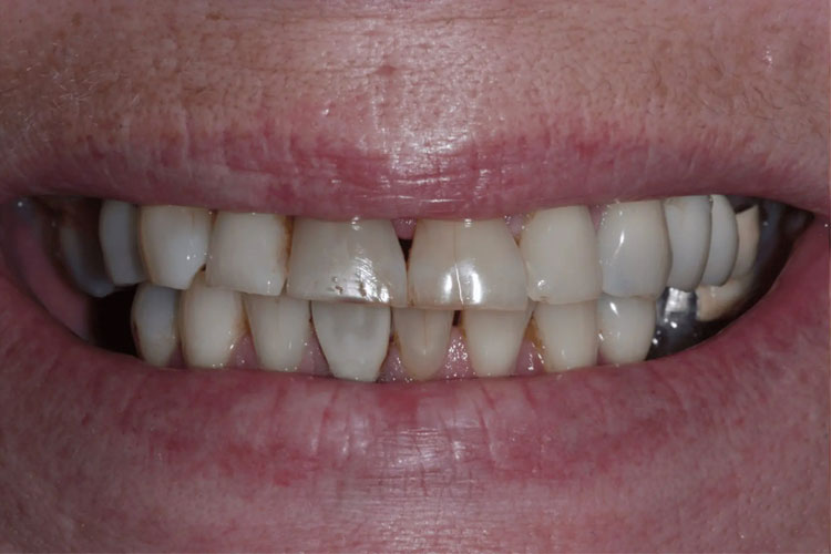 manchester dental crowns before after manchester dental crowns before after