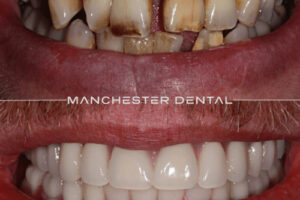 Manchester dental implants before and after Manchester dental implants before and after
