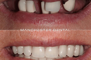 Manchester dental implants before and after Manchester dental implants before and after