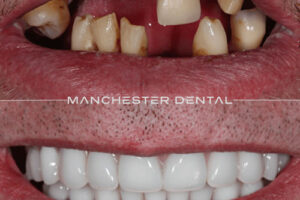 Manchester dental implants before and after Manchester dental implants before and after