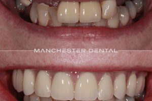 Manchester dental implants before and after Manchester dental implants before and after