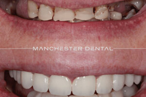 Manchester dental implants before and after Manchester dental implants before and after