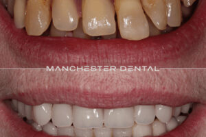 Manchester dental implants before and after Manchester dental implants before and after