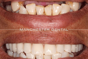 Manchester dental implants before and after Manchester dental implants before and after