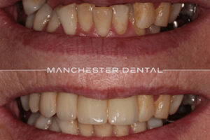 Manchester dental implants before and after Manchester dental implants before and after