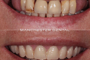 Manchester dental implants before and after Manchester dental implants before and after