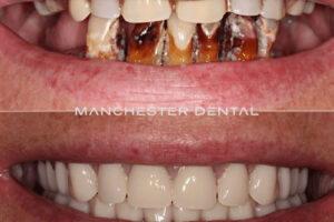Manchester dental implants before and after Manchester dental implants before and after
