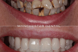 Manchester dental implants before and after Manchester dental implants before and after