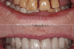 Manchester dental implants before and after Manchester dental implants before and after