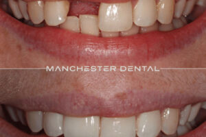 Manchester dental implants before and after Manchester dental implants before and after