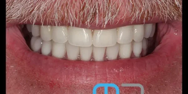 Manchester Dental same day implants Before and after
