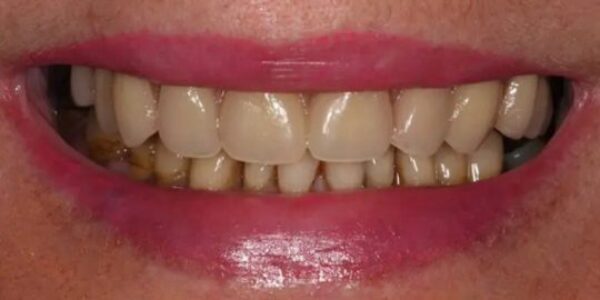 Manchester Dental same day implants Before and after