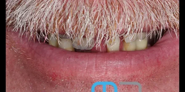 Manchester Dental same day implants Before and after Manchester Dental same day implants Before and after