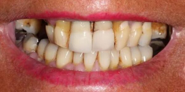 Manchester Dental same day implants Before and after Manchester Dental same day implants Before and after