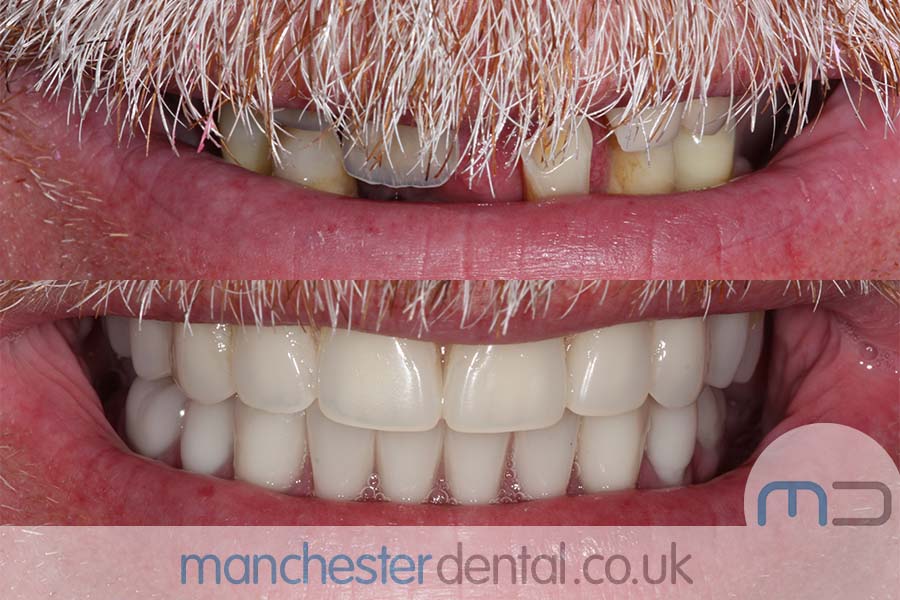 Manchester Dental same day implants Before and after Manchester Dental same day implants Before and after