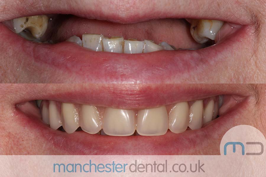 Manchester Dental same day implants Before and after Manchester Dental same day implants Before and after