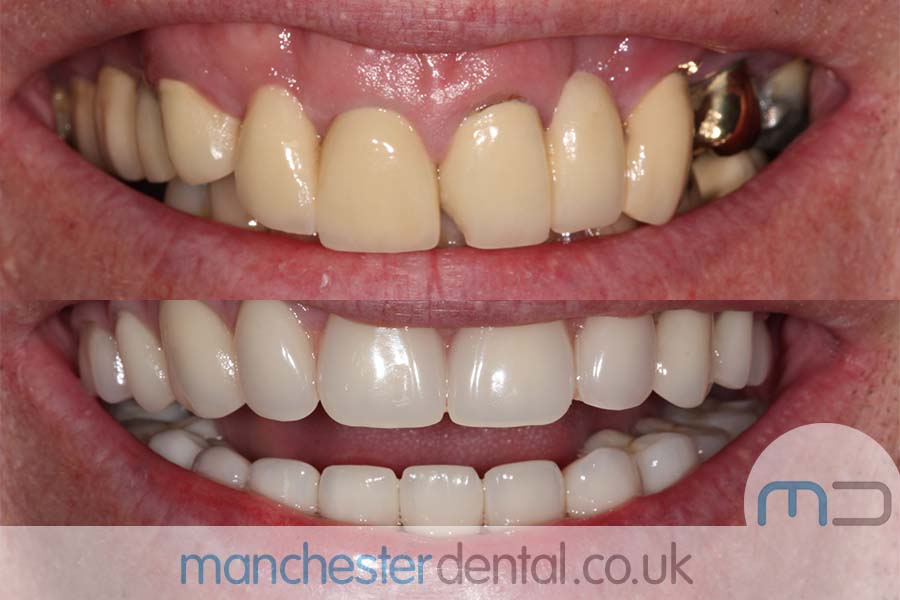 Manchester Dental same day implants Before and after Manchester Dental same day implants Before and after