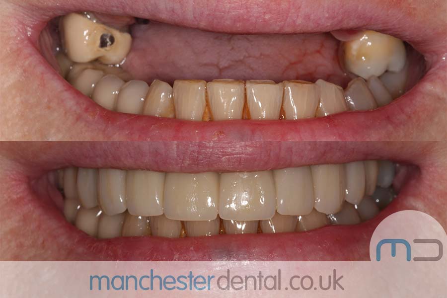 Manchester Dental same day implants Before and after Manchester Dental same day implants Before and after